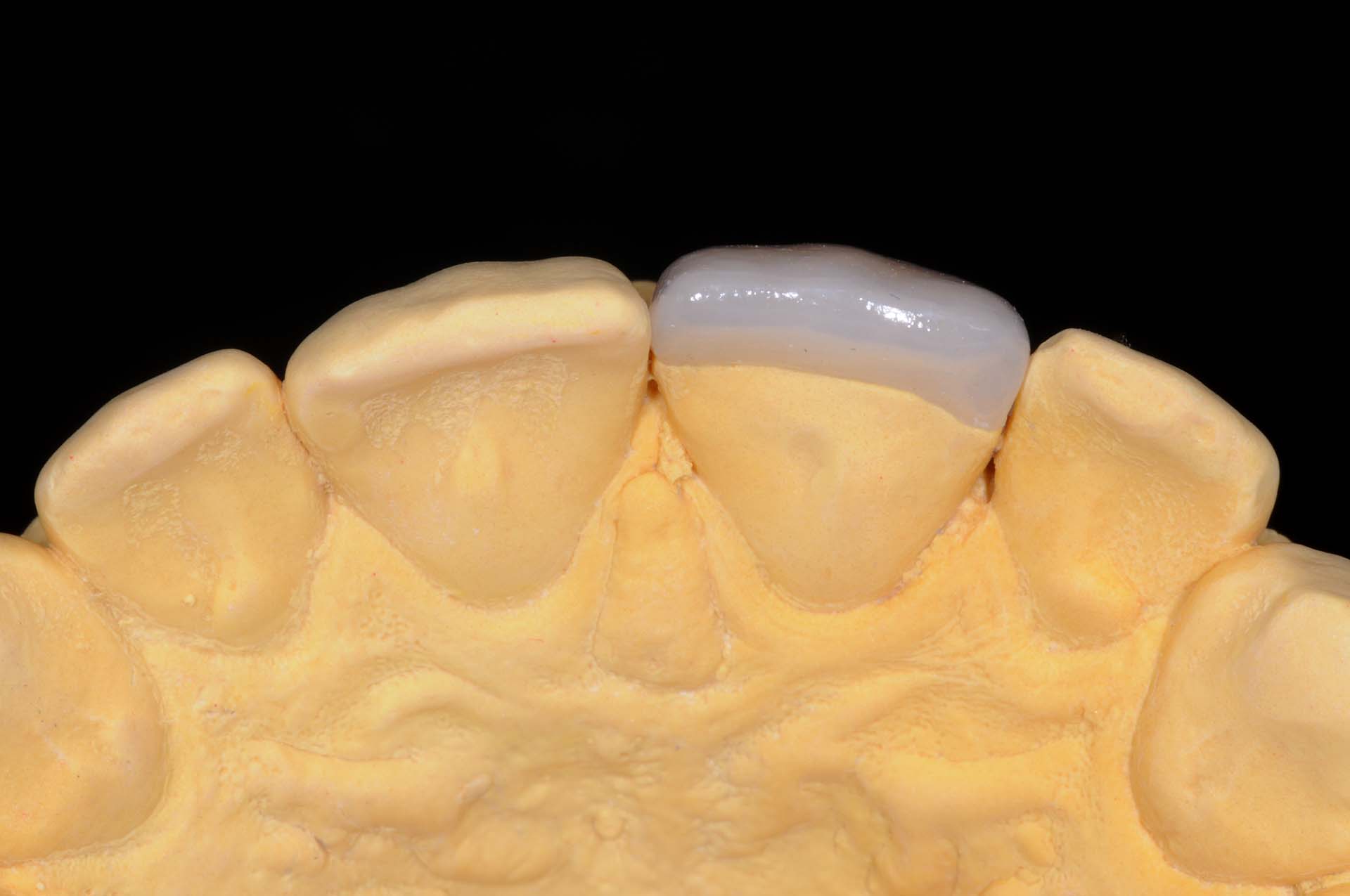 Veneer 21